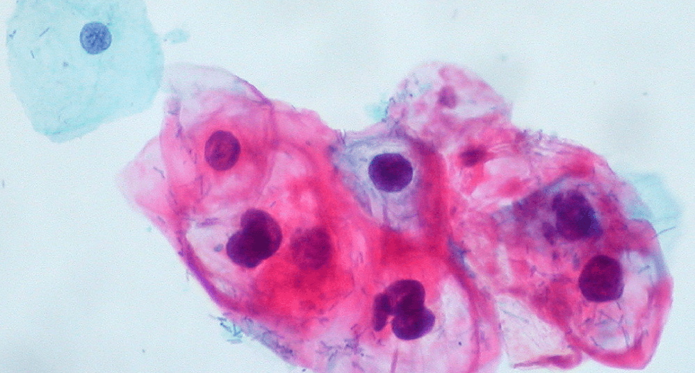 cervical cells smear test CIN1 2